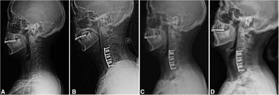 Is 3D-printed Titanium cage a reliable option for 3-level anterior cervical discectomy and fusion in treating degenerative cervical spondylosis?